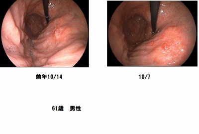 胃癌の症状は？