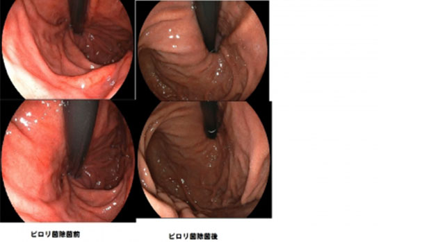 ピロリ菌　除菌前と除菌後