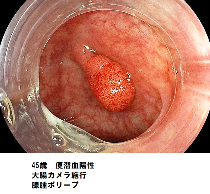 大腸カメラでポリープが見つかる　いとうファミリークリニック